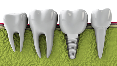 Dental Implant