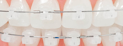 Brace Sapphire orthodontic in Smile Tijuana