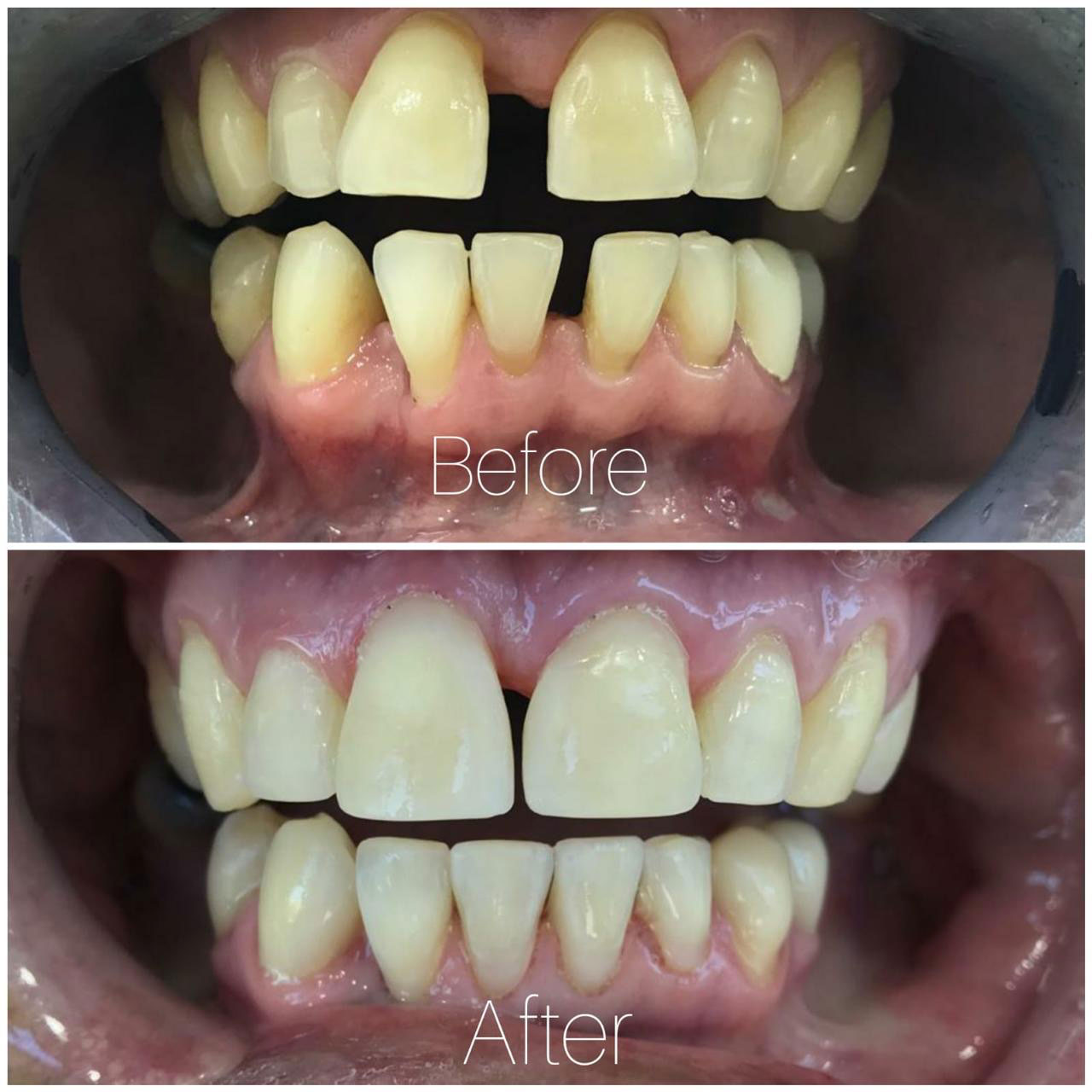 composite-veneers-in-tijuana-smile-tijuana-dentist-2