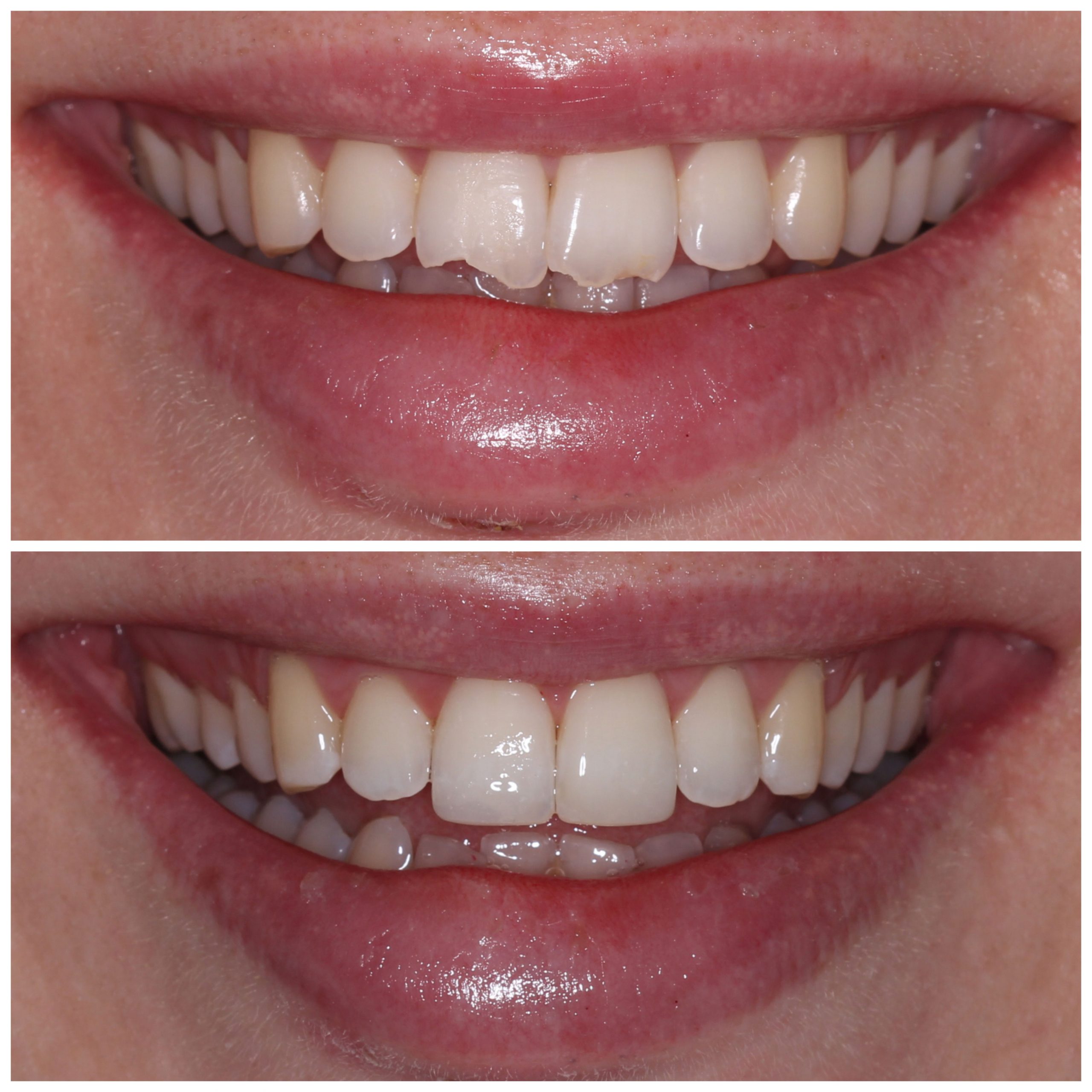 composite-veneers-in-tijuana-smile-tijuana-dentist-3