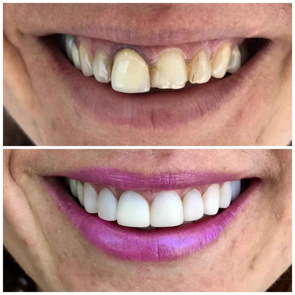 composite-veneers-in-tijuana-smile-tijuana-dentist